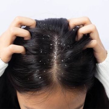 وصفات طبيعية لعلاج قشرة الشعر بسهوله للاطفال والبالغين