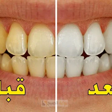 لابتسامة نجوم هوليود.. طرق مضمونة لتبييض الأسنان بمكونات طبيعية وفعالة هتشيل الصفار في دقايق