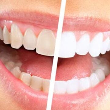 طرق منزلية سحرية للتخلص من الجير على الأسنان والحفاظ على اللثة