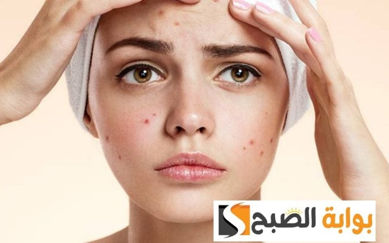 وصفة لإزالة حبوب الوجه وخاصة الأنف بمكونات طبيعية بدون مستحضرات تجميل